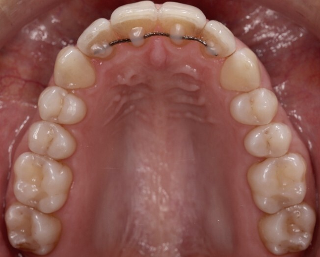 Caso 1 - despues Caso 1 - despues