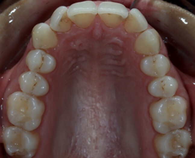 Caso 1 -antes Caso 1 -antes