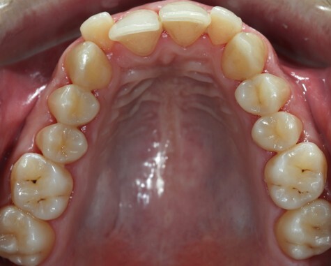 Caso3 - antes Caso3 - antes
